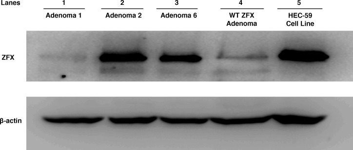 Western blot analysis of ZFX expression in parathyroid adenomas