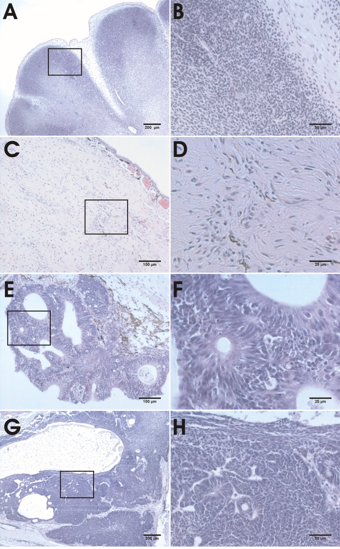 Histological analysis of hind limb, desmoid, epidermal and brain neoplasias of apc TALEN mRNA (40 pg) injected tadpoles and froglets