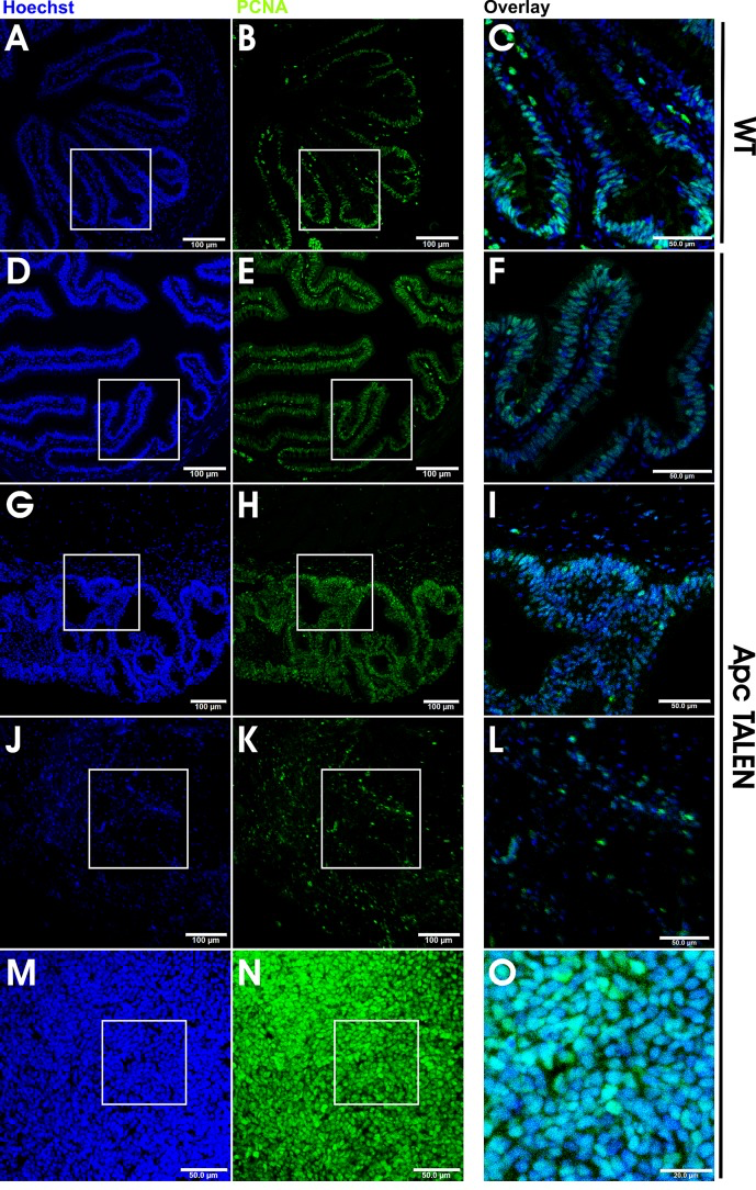 Increased and mislocalized proliferation in apc TALEN induced tumors