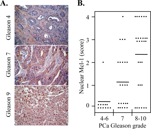 Nuclear localization of Mcl-1 is more frequent in high Gleason grade PCa